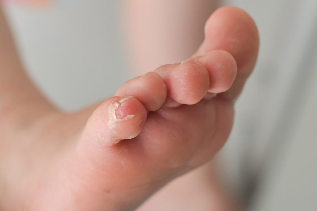 Enterovirus foot hand mouth Skin peeled off on the body of a child Cocksackie virus
